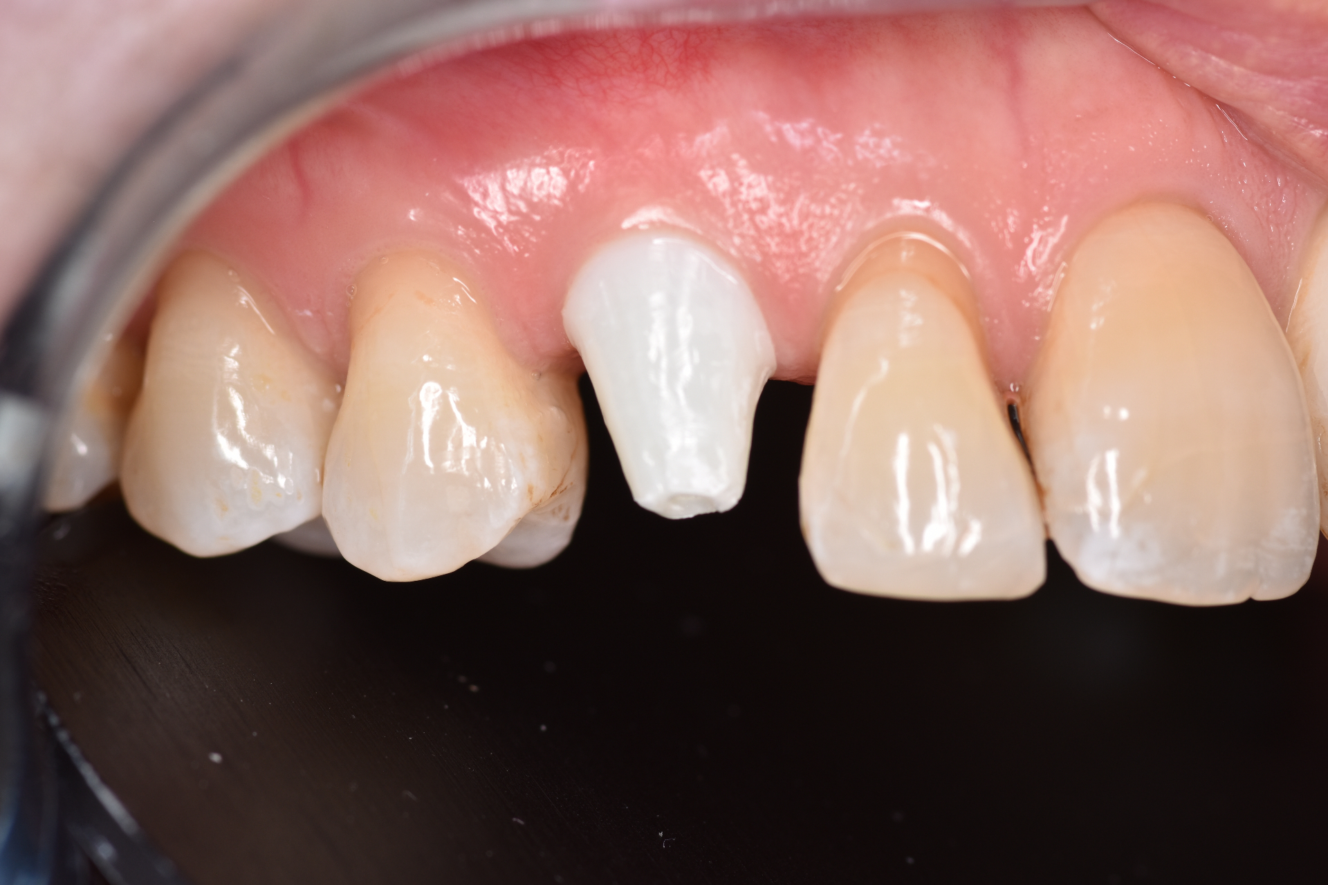 Keramische Implantaten, de biologisch duurzame keuze